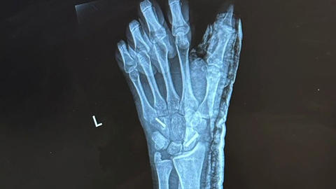 X-ray of hand.